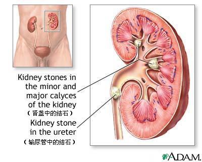 <em>肾结石症状表现</em>_上海结石病医院
